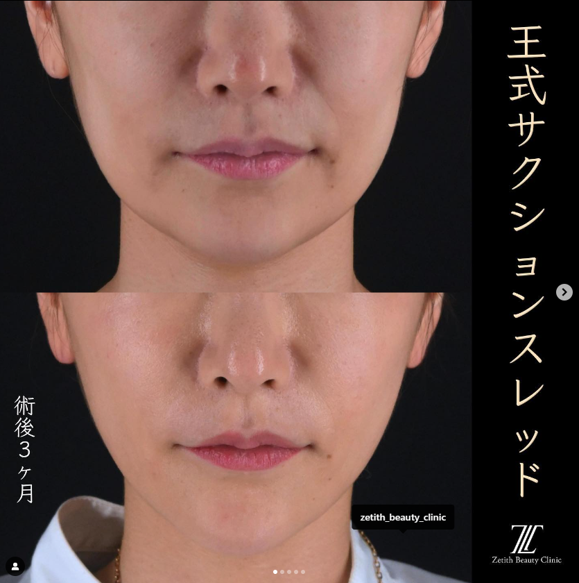 王医師による複合治療の施術前／施術後3ヶ月