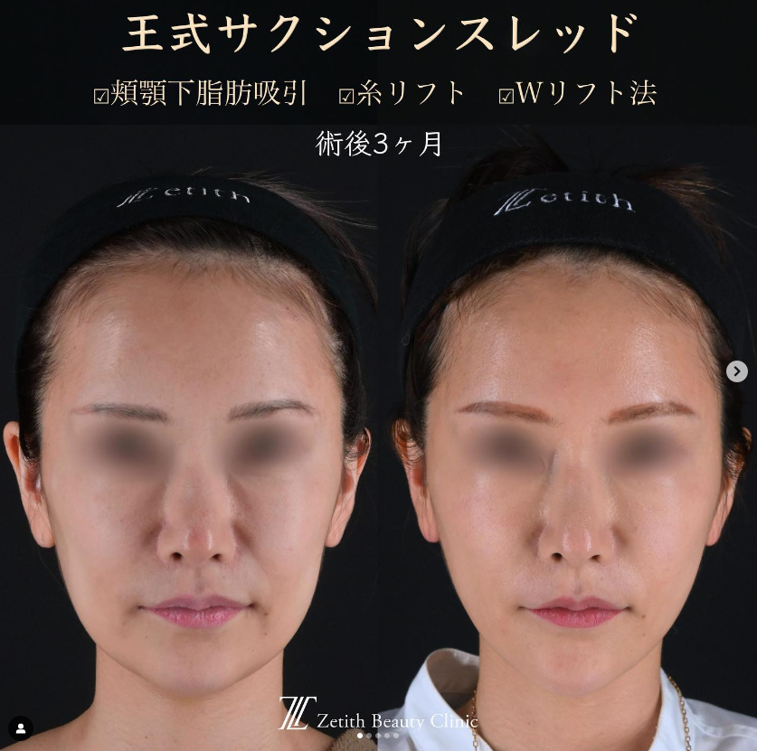 王医師による複合治療の施術前／施術後3ヶ月 术后 
