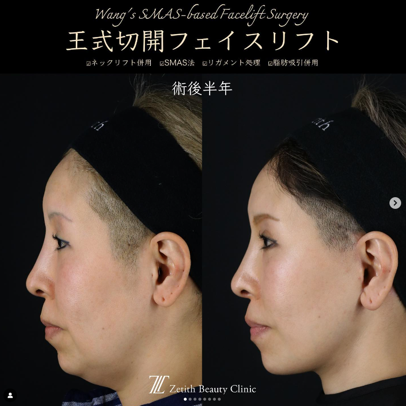 王医師によるフェイスリフトの施術前／施術後6ヶ月