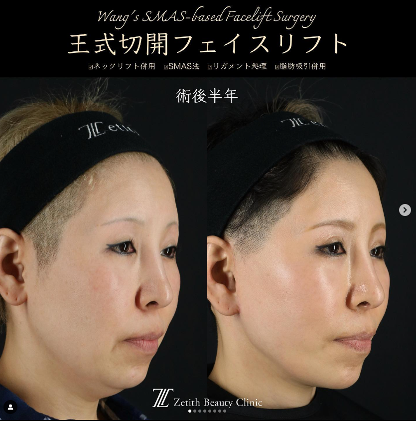 王医師によるフェイスリフトの施術前／施術後6ヶ月 施術後 