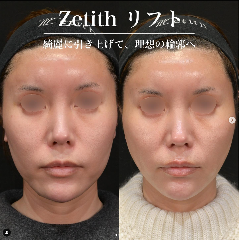 新井医師によるショッピングリフトの施術前／施術後1週間