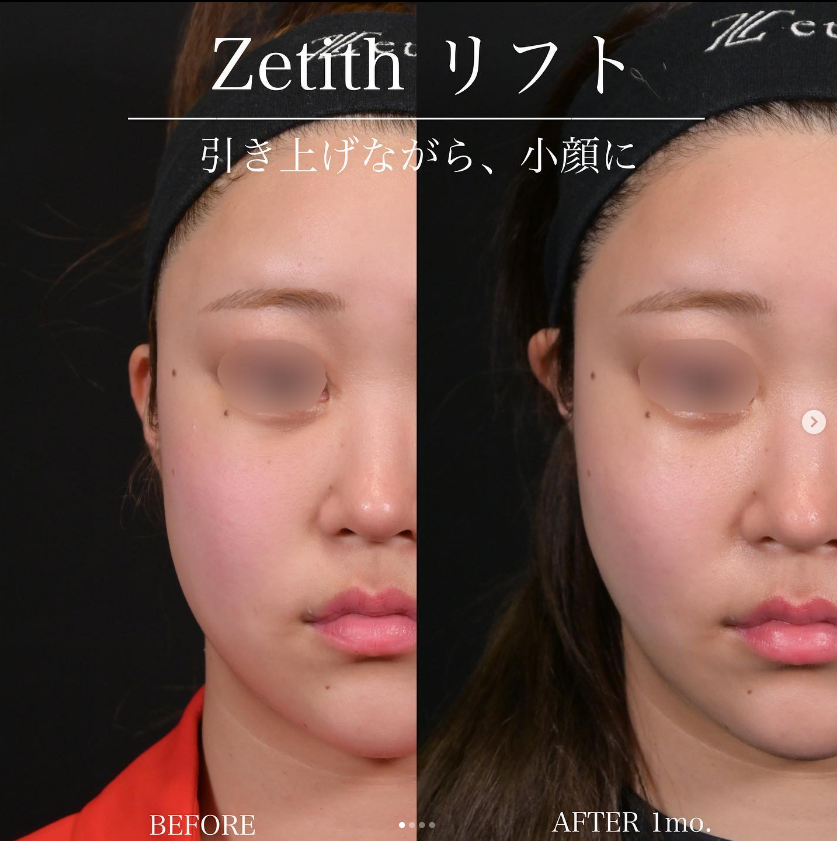 新井医師による糸リフトの施術前／施術後1ヶ月