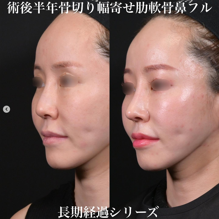 鉄医師による鼻のフルコースの施術前／施術後6ヶ月