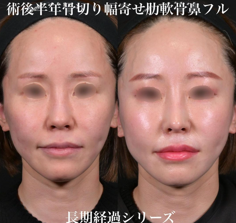 鉄医師による鼻のフルコースの施術前／施術後6ヶ月 施術後 