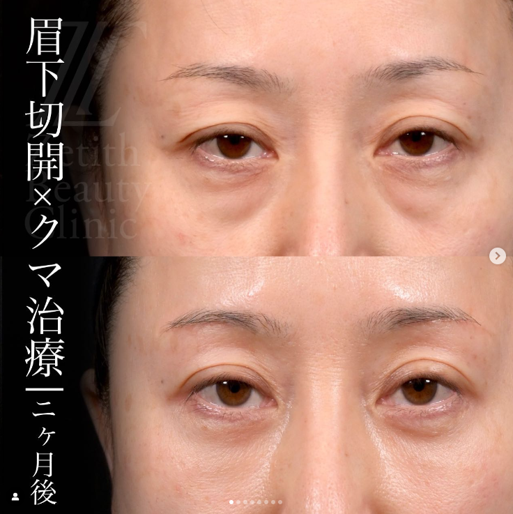 守屋医師による複合治療の施術前／施術後2ヶ月