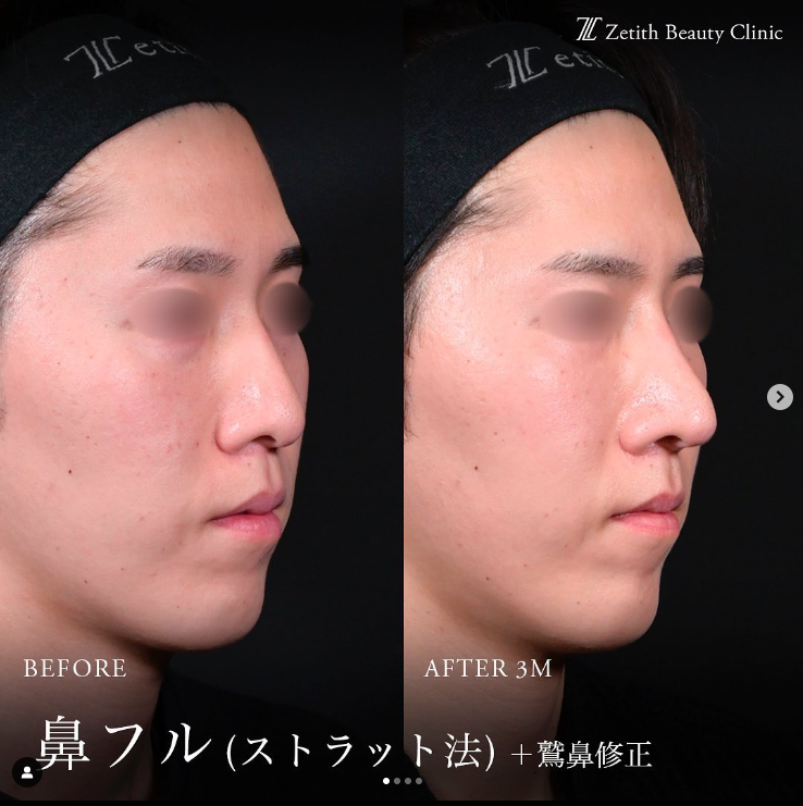 守屋医師による鼻整形の施術前／施術後3ヶ月