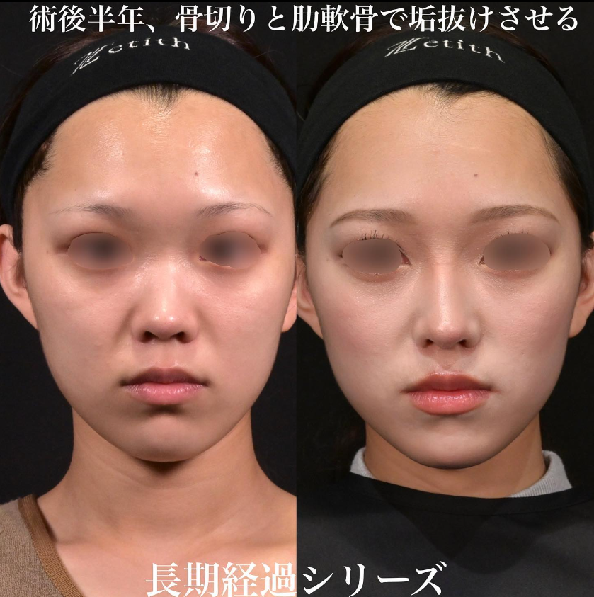 鉄医師による鼻のフルコースの施術前／施術後6ヶ月