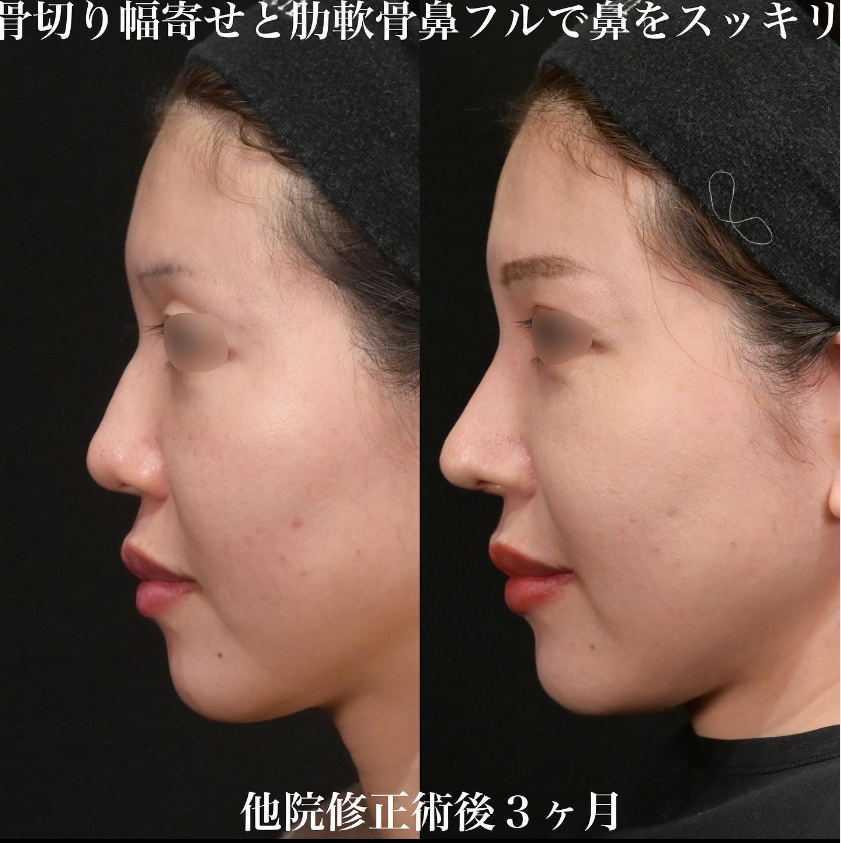 鉄医師による鼻のフルコースの施術前／施術後3ヶ月