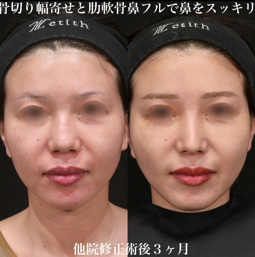 鉄医師による鼻のフルコースの施術前／施術後3ヶ月 หลัง 