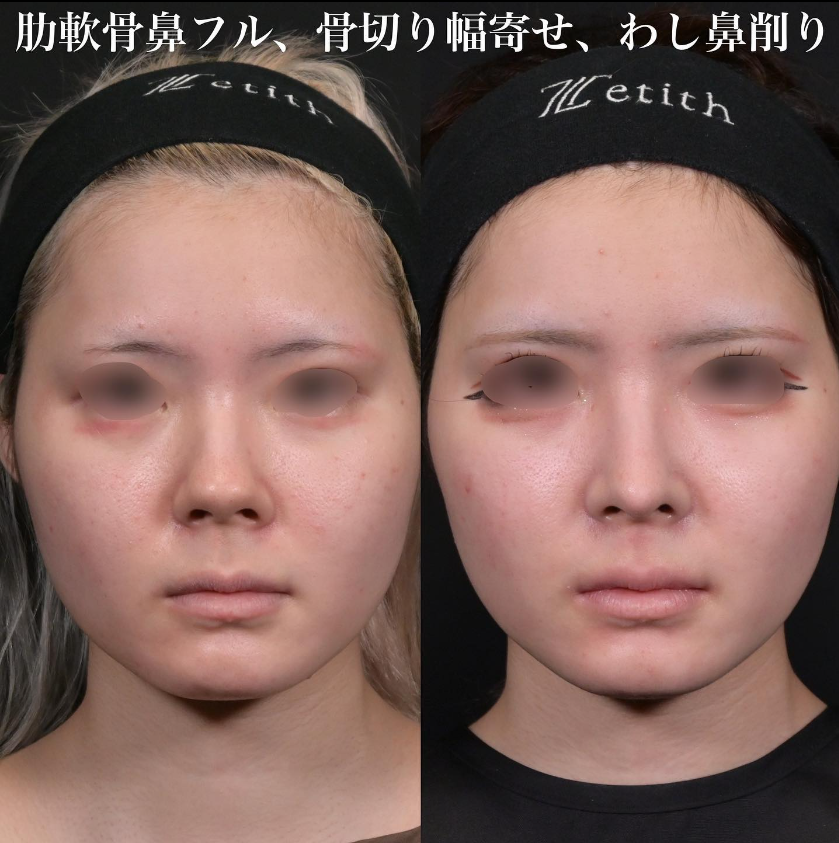 鉄医師による鼻のフルコースの施術前／施術後2カ月 施術後 