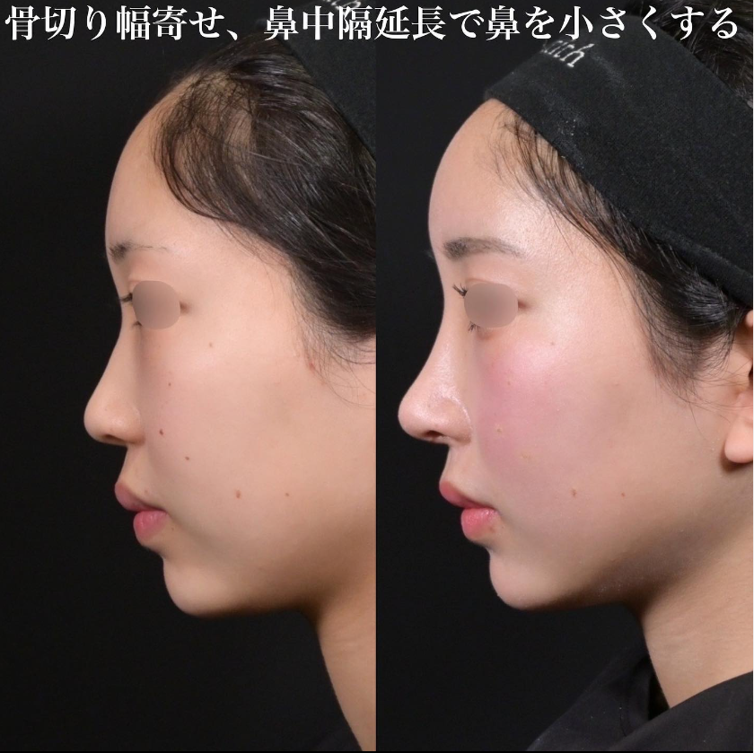 鉄医師による鼻のフルコースの施術前／施術後1ヶ月