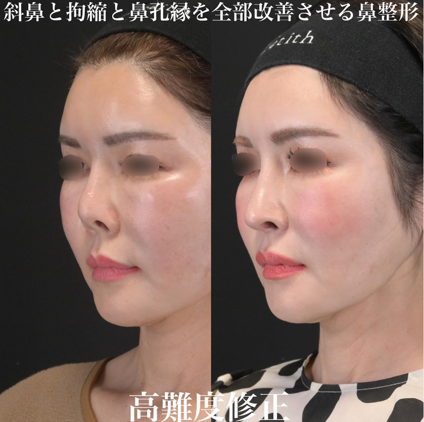鉄医師による鼻のフルコースの施術前／施術後1ヶ月 施術後 