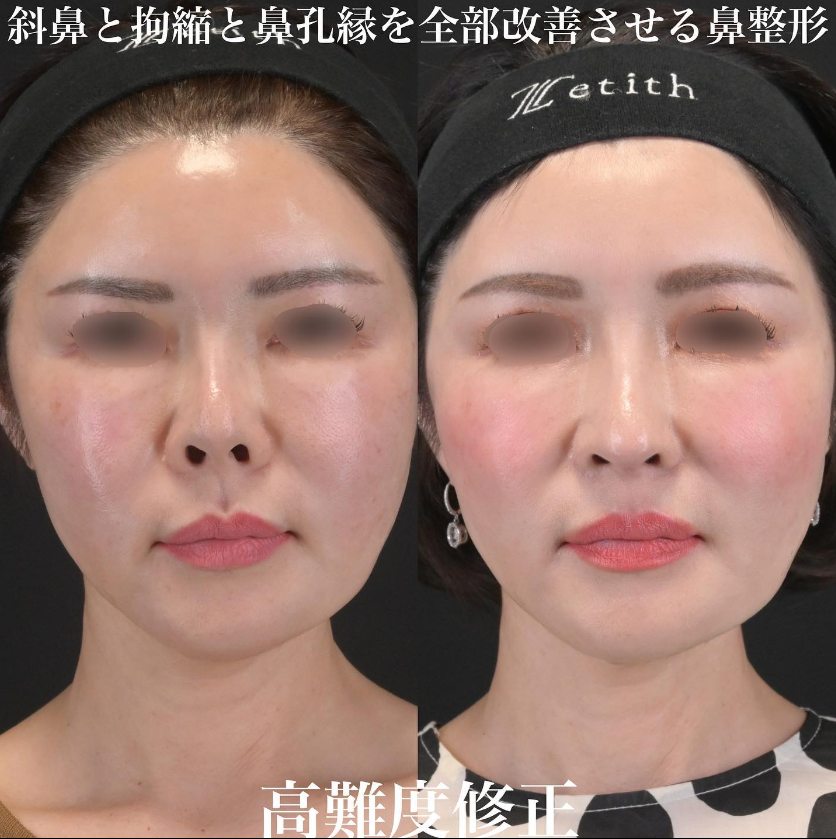 鉄医師による鼻のフルコースの施術前／施術後1ヶ月