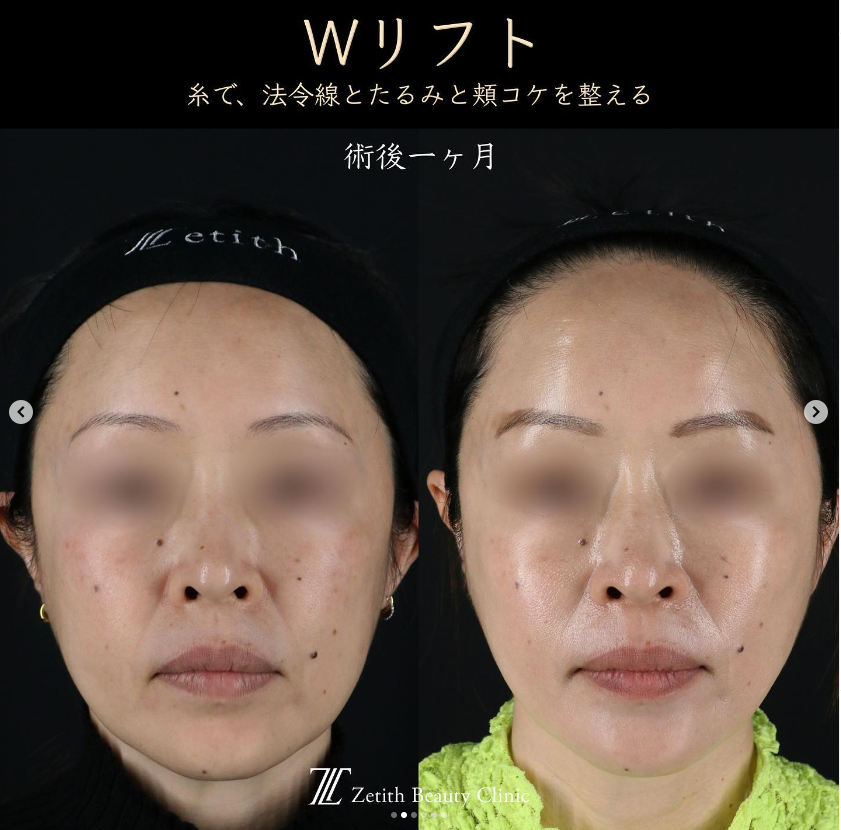 王医師による糸リフトの施術前／施術後1ヶ月 Sonra 