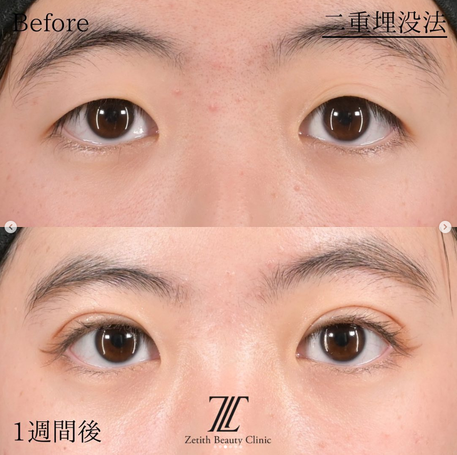 林医師にょる二重埋没法の施術前／施術後1週間