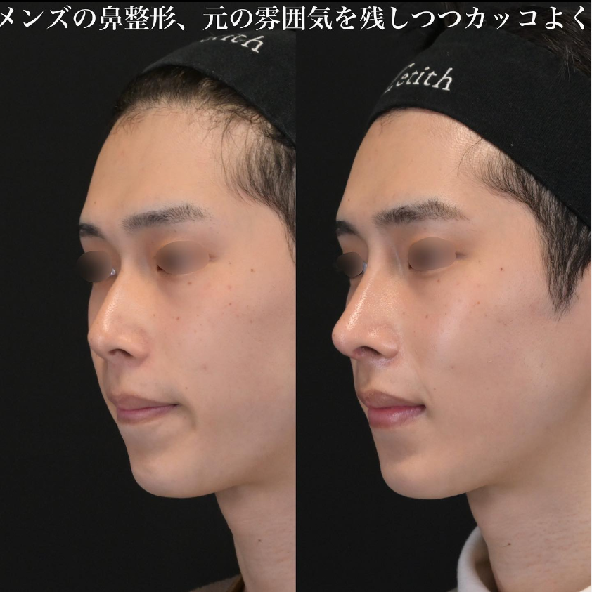 鉄医師による鼻フルコースの施術前／施術後1ヶ月