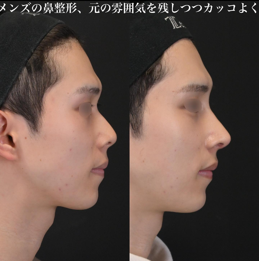 鉄医師による鼻フルコースの施術前／施術後1ヶ月 术后 