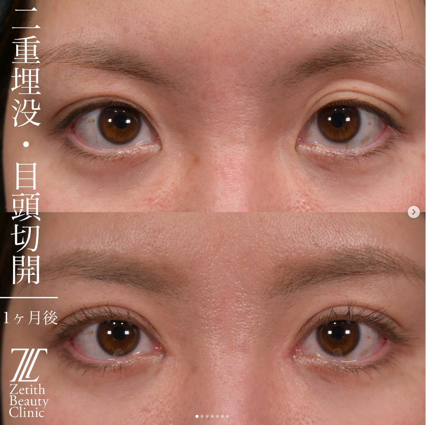 上木原医師による目元複合手術の施術前／施術後1ヶ月