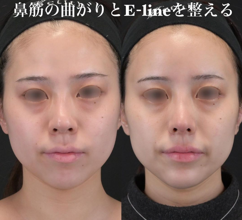 鉄医師による鼻フルコースの施術前／施術後1ヶ月