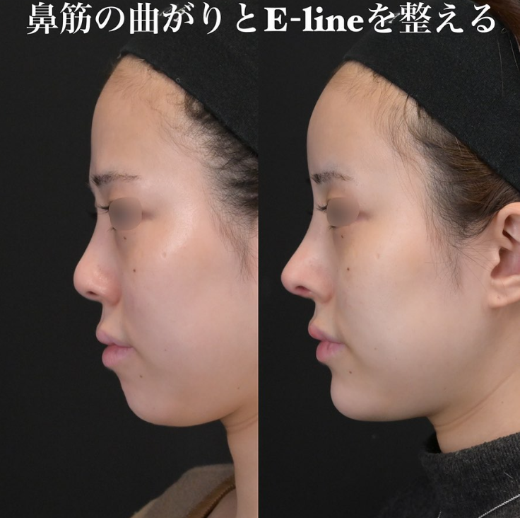 鉄医師による鼻フルコースの施術前／施術後1ヶ月 หลัง 