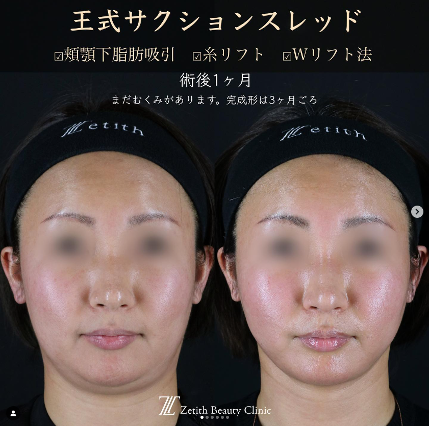 王医師による複合手術の施術前／施術後1ヶ月