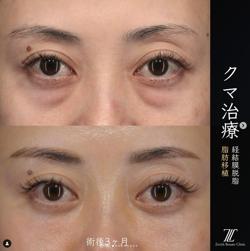 王医師によるクマ治療の施術前／施術後3ヶ月