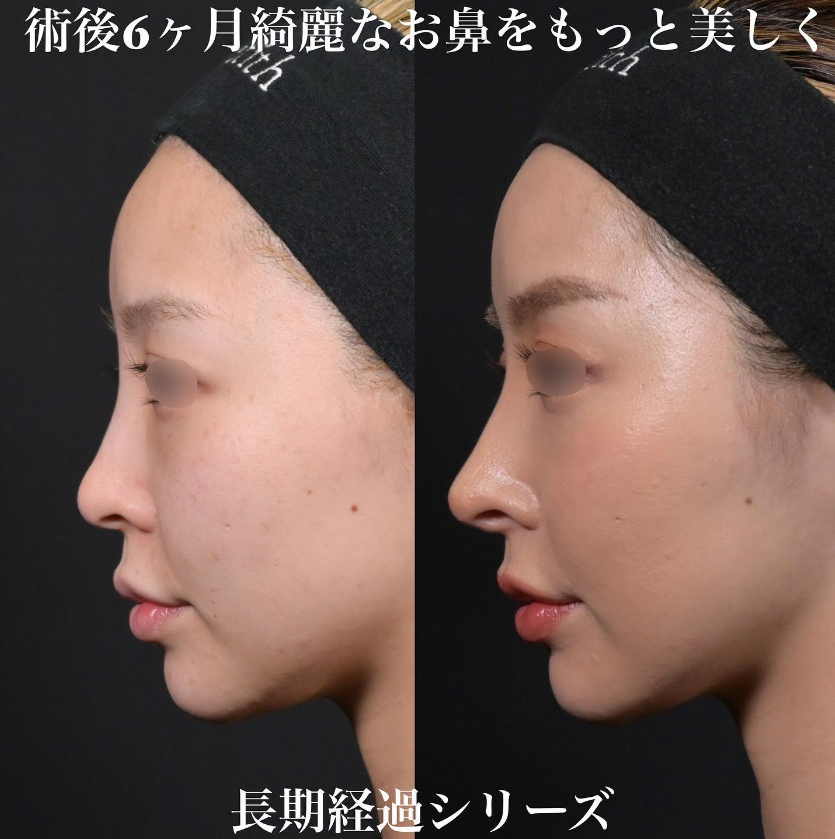 鉄医師による鼻フルコースの施術前／施術後6ヶ月