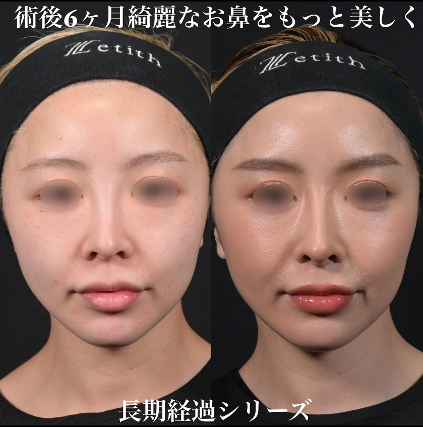 鉄医師による鼻フルコースの施術前／施術後6ヶ月 หลัง 