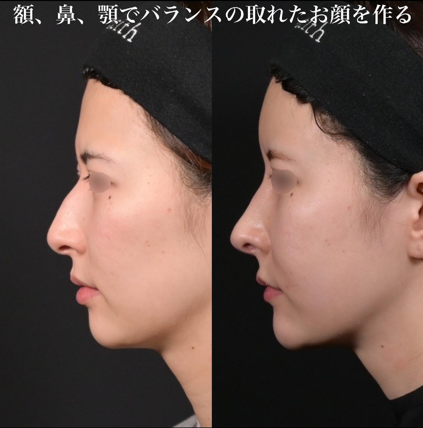 鉄医師による鼻フルコースの施術前／施術後3ヶ月