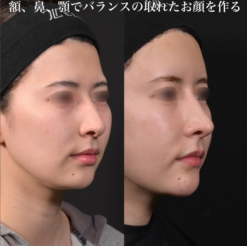 鉄医師による鼻フルコースの施術前／施術後3ヶ月 施術後 