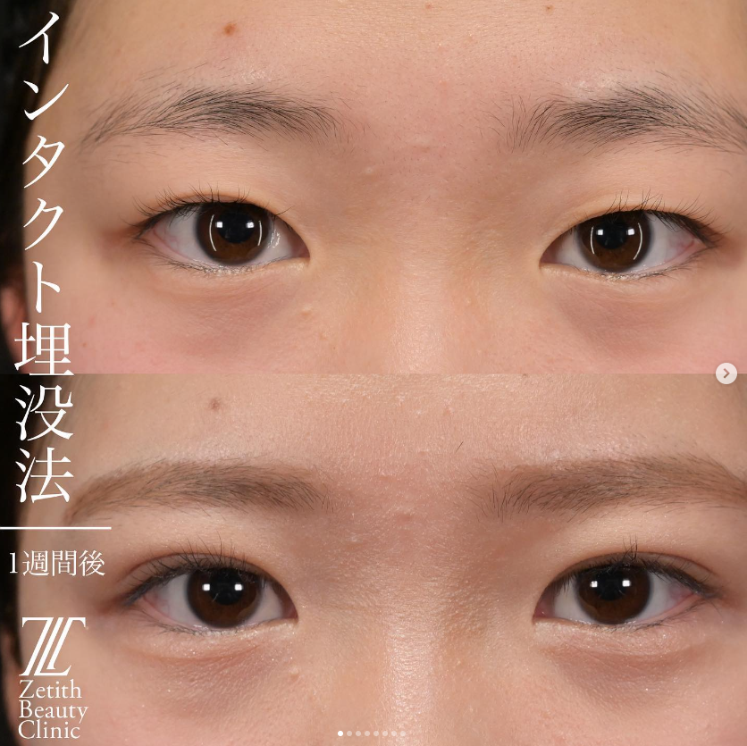 上木原医師による二重埋没の施術前／施術後1週間