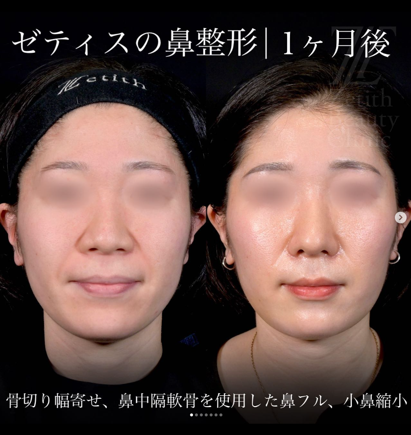 守屋医師による鼻フルコースの施術前／施術後1ヶ月