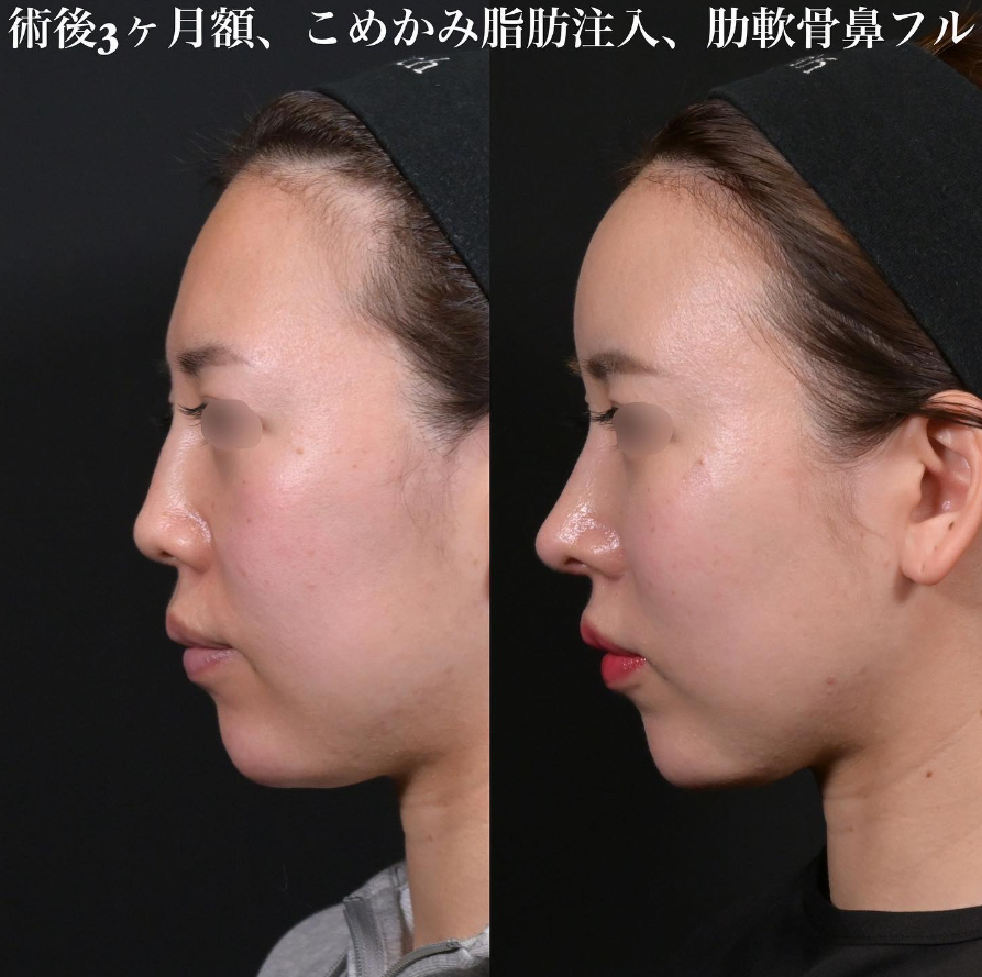 鉄医師による鼻フルコースの施術／施術後3ヶ月 术后 