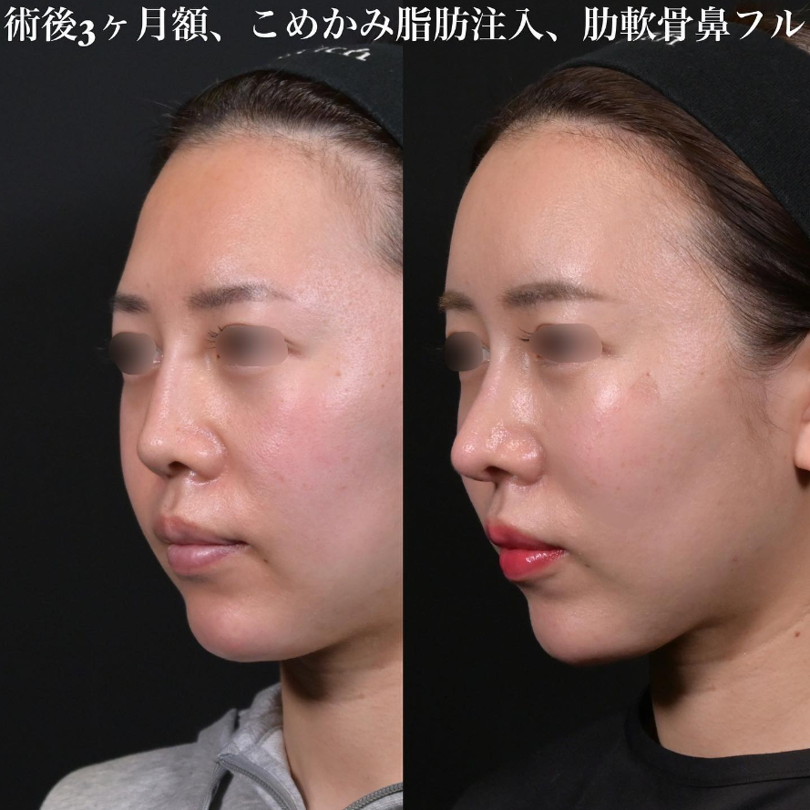 鉄医師による鼻フルコースの施術／施術後3ヶ月
