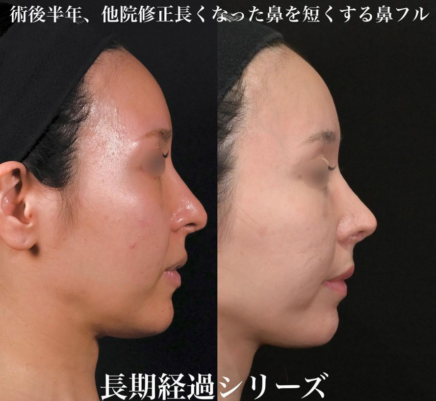 鉄医師による鼻フルコースの施術前／施術後6ヶ月