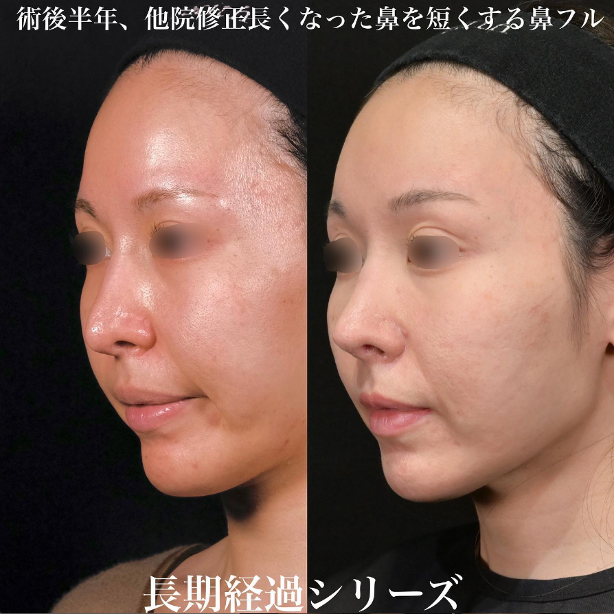 鉄医師による鼻フルコースの施術前／施術後6ヶ月 Sau 