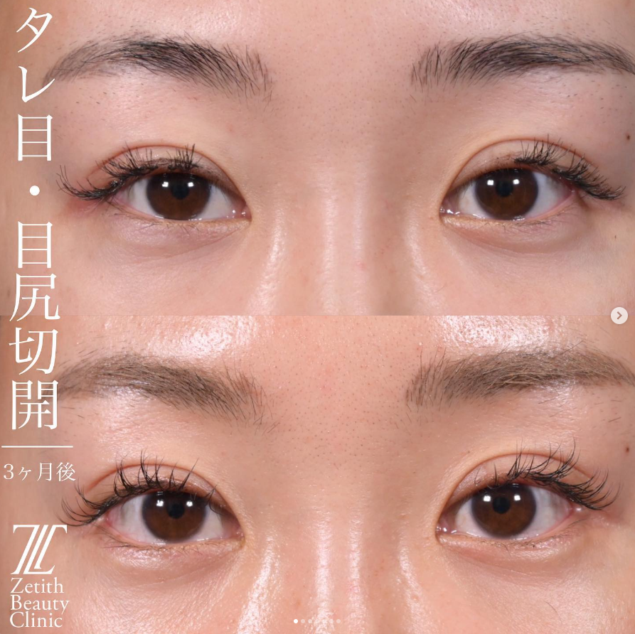 上木原医師による目元複合治療の施術前／施術後3ヶ月