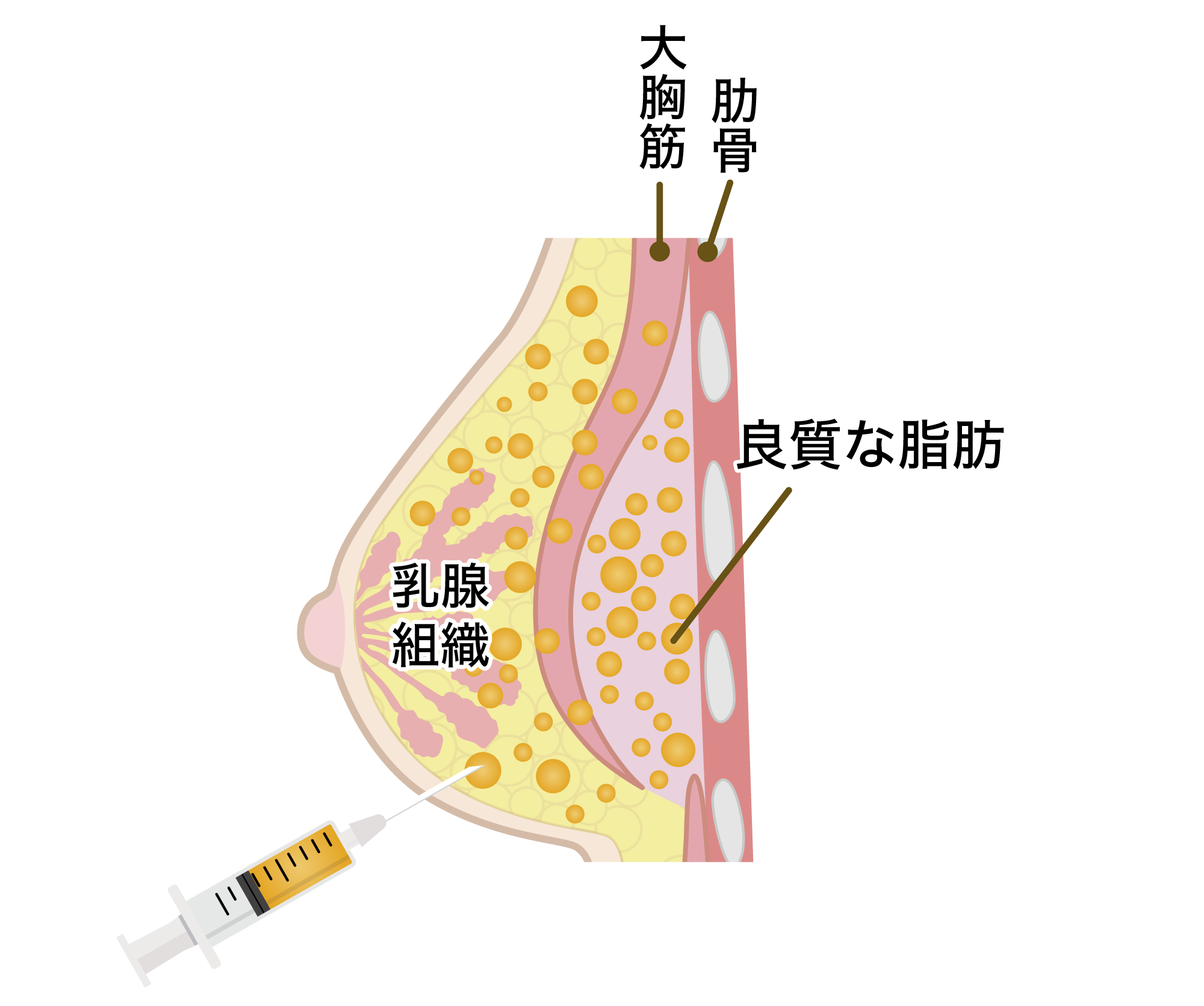 脂肪の定着率低下、しこり回避をするために