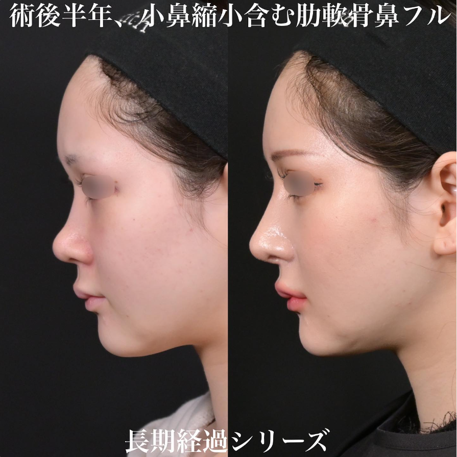 鉄医師による鼻整形の施術前／施術後6ヶ月