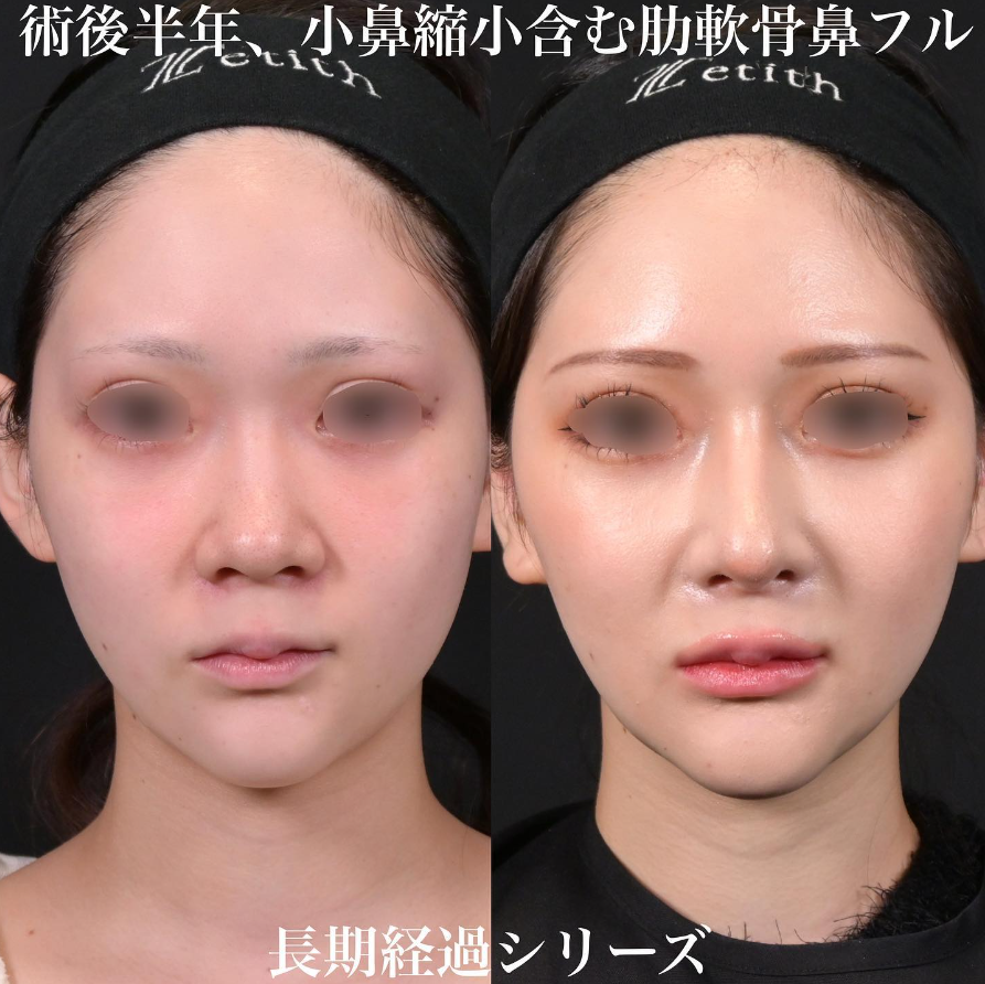 鉄医師による鼻整形の施術前／施術後6ヶ月 施術後 