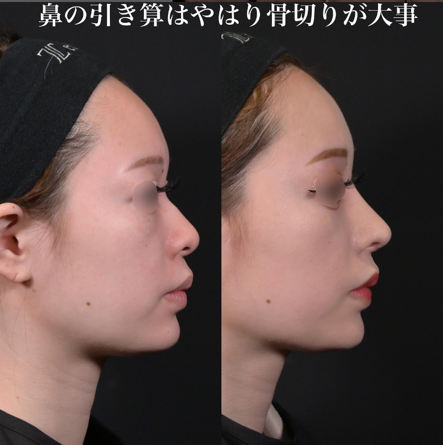 鉄医師による鼻整形の施術前／施術後1ヶ月