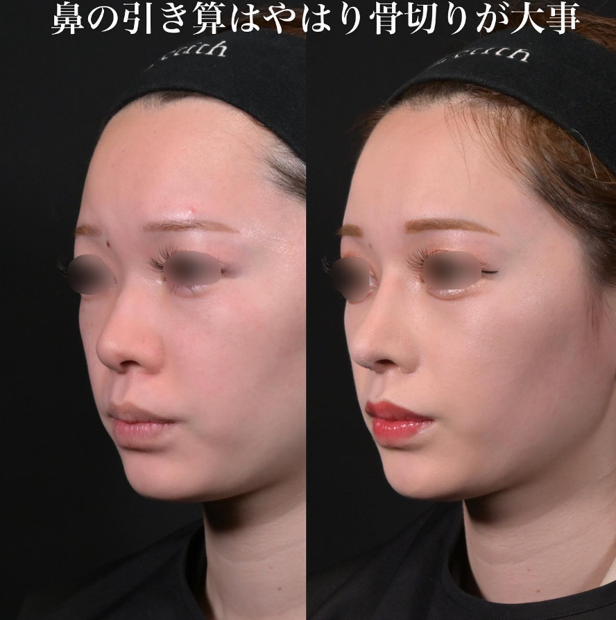 鉄医師による鼻整形の施術前／施術後1ヶ月 术后 