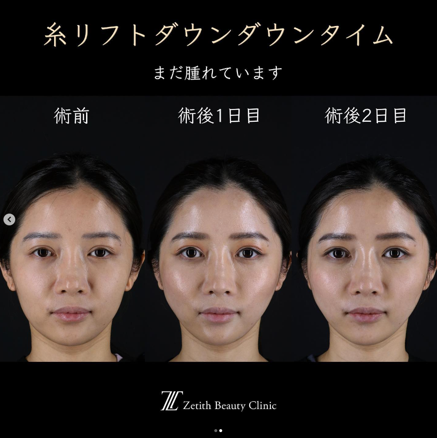 王医師による糸リフトの施術前／施術後2日 施術後 