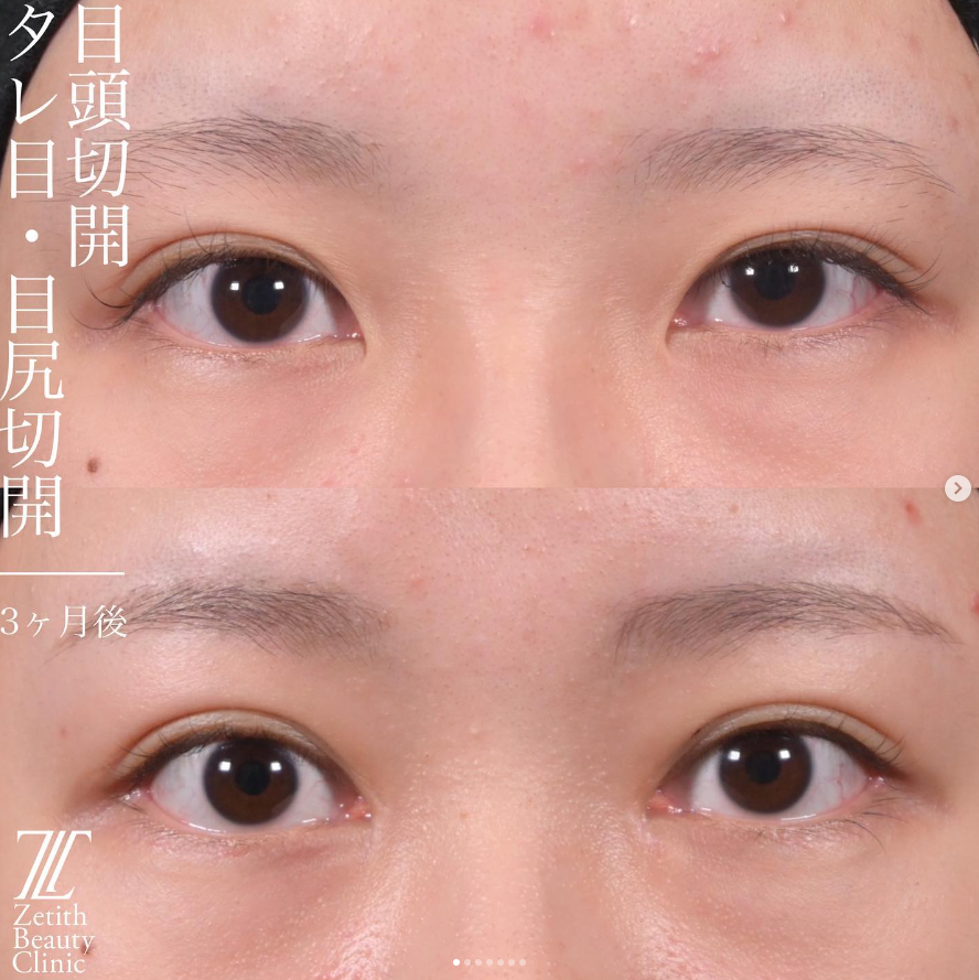 上木原医師による目元整形の施術前／施術後3ヶ月
