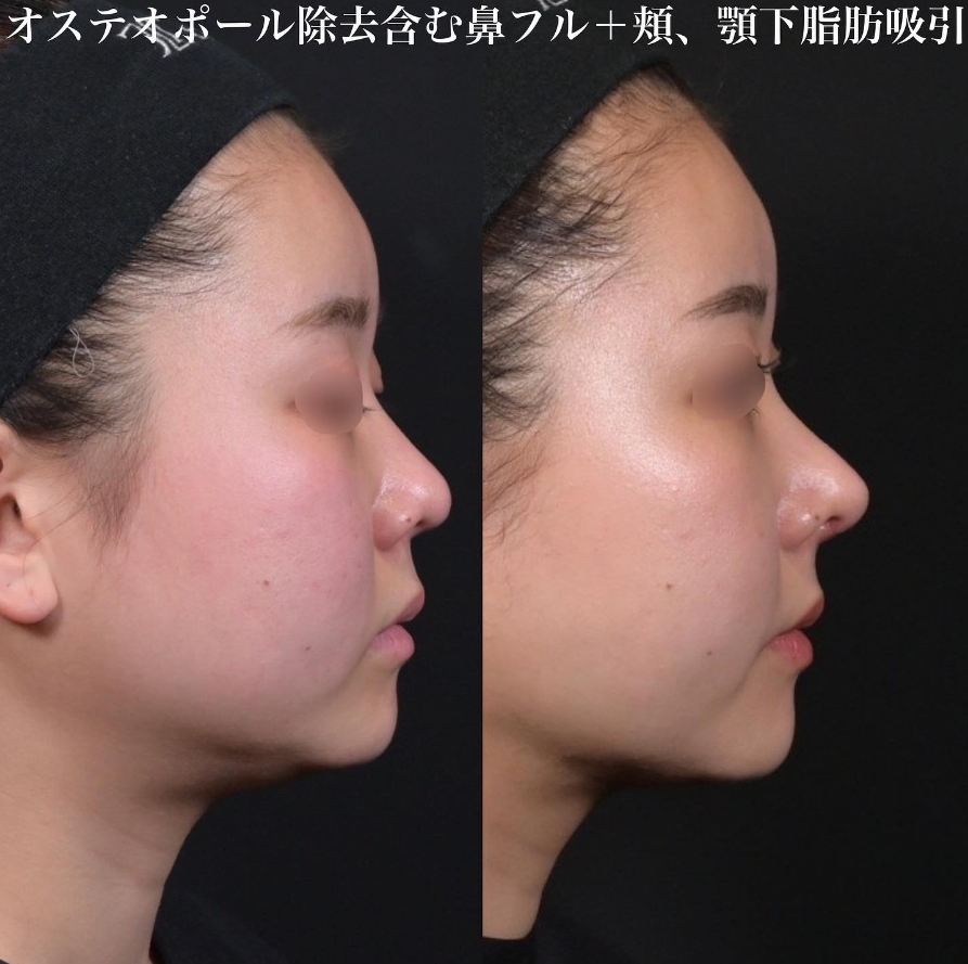 鉄医師による鼻整形の施術前／施術後1ヶ月