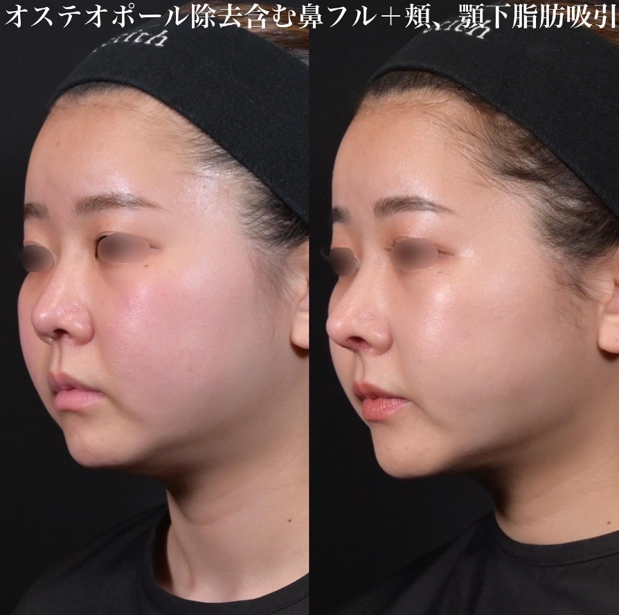 鉄医師による鼻整形の施術前／施術後1ヶ月 术后 