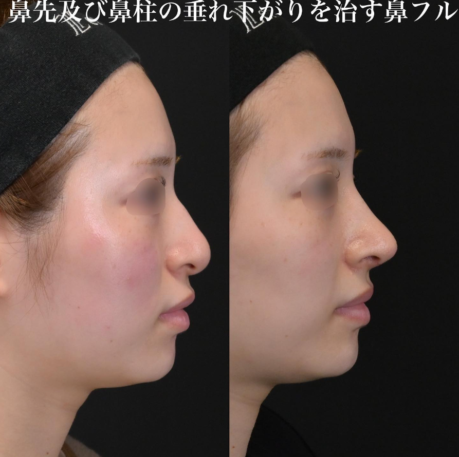 鉄医師による鼻整形の施術前／施術後1ヶ月