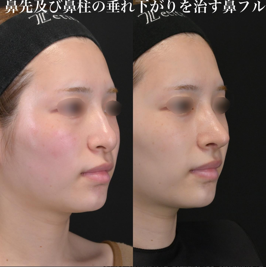 鉄医師による鼻整形の施術前／施術後1ヶ月 施術後 