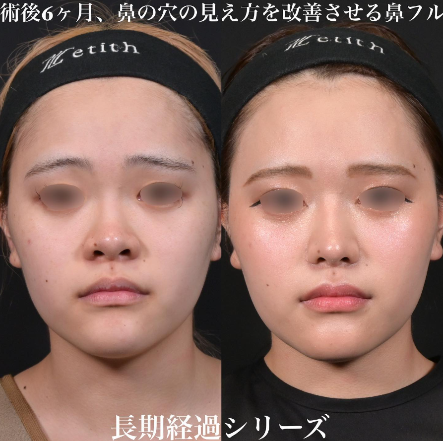 鉄医師による鼻整形の施術前／施術後6ヶ月
