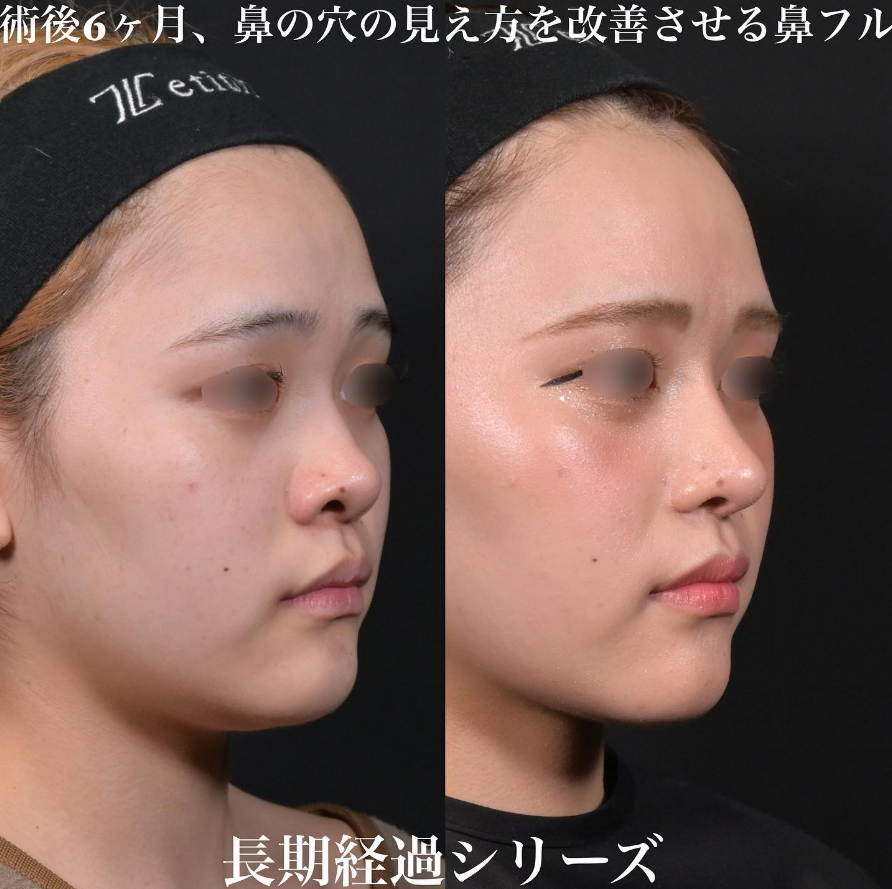 鉄医師による鼻整形の施術前／施術後6ヶ月 Дараа 